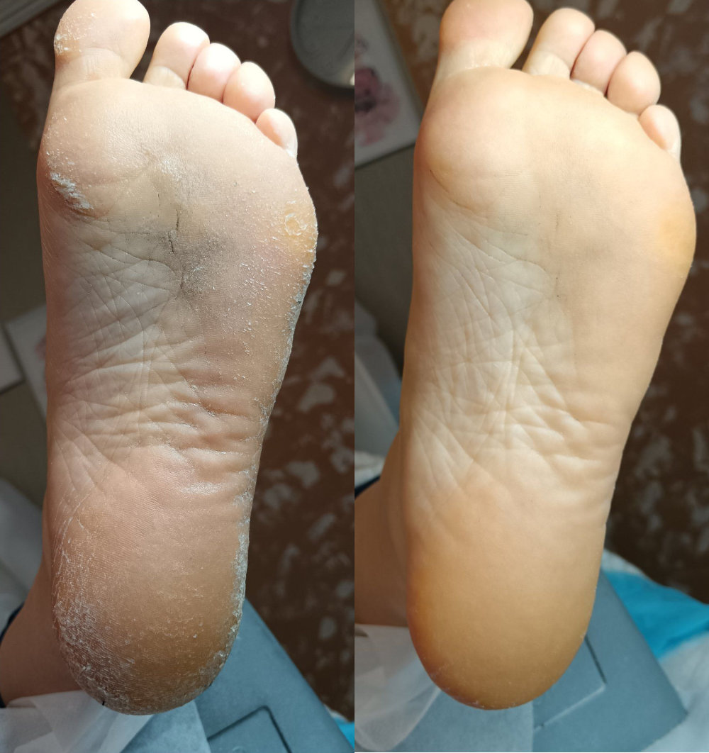 Előtte Utána Eredmény 1